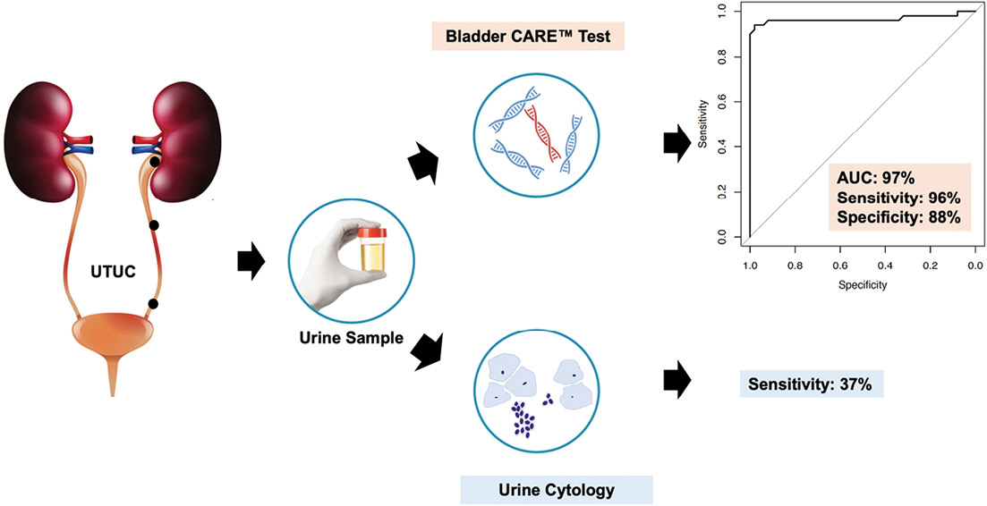 Ju Insight A Urine Based Dna Methylation Marker Test To Detect Upper Tract Urothelial Carcinoma